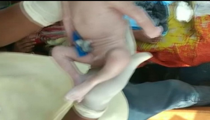 baby born without head